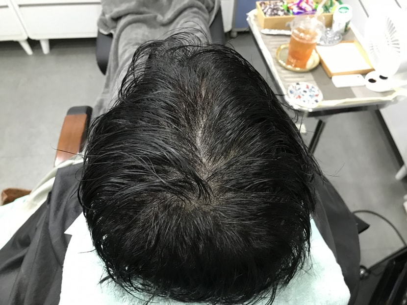 수술 후