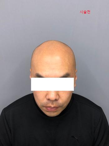 시술전