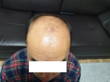 시술전