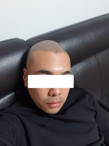 시술완료
