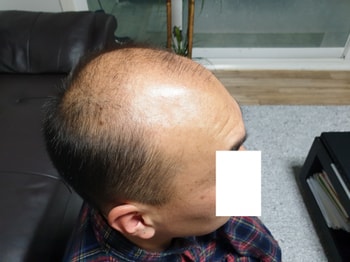 시술전