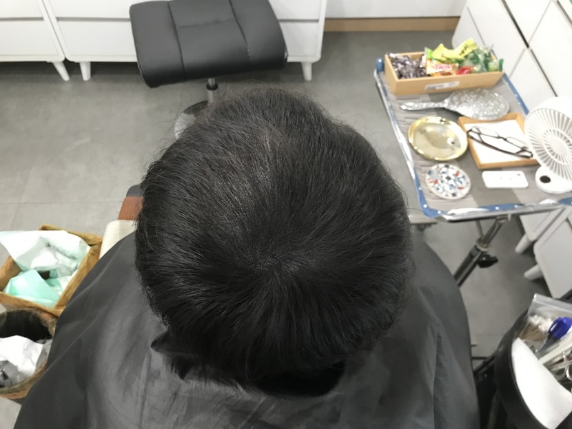 시술후
