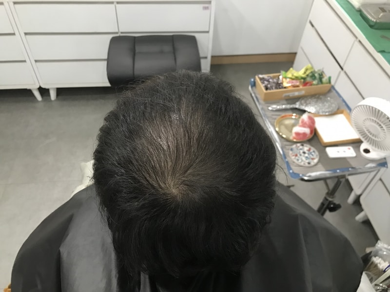 頭皮タトゥーの体験談です。