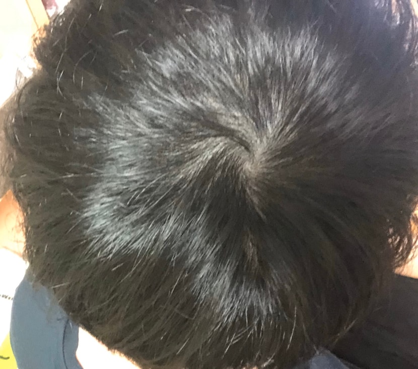1차 후 일주일 후