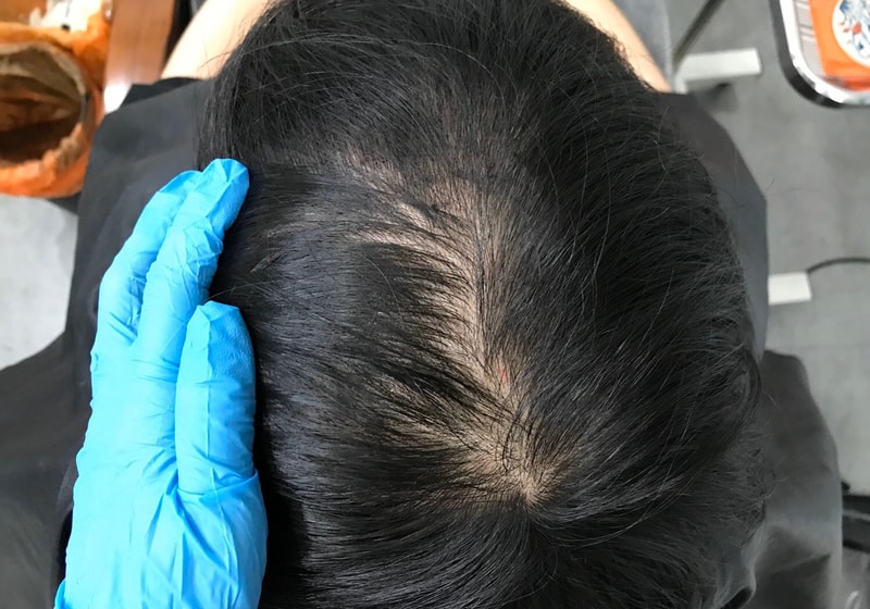 두피문신후기입니다.