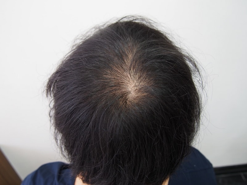 두피문신 후기 - 한달정도 됬습니다.