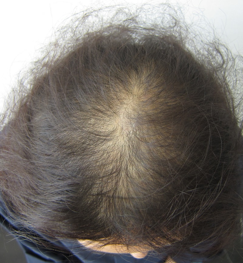 是头皮纹身后记!!!