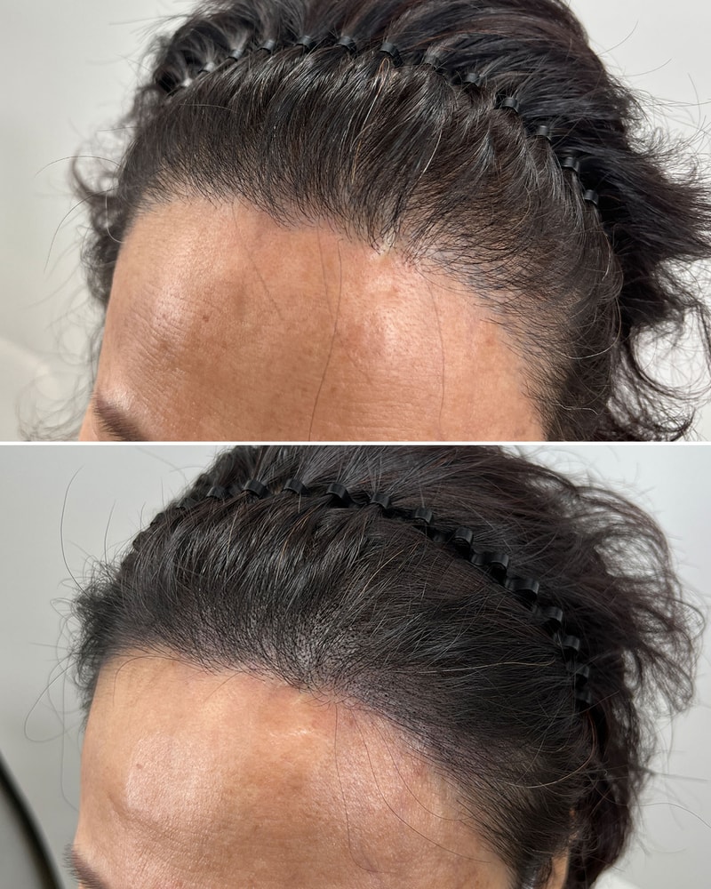 母の頭皮を刺しました