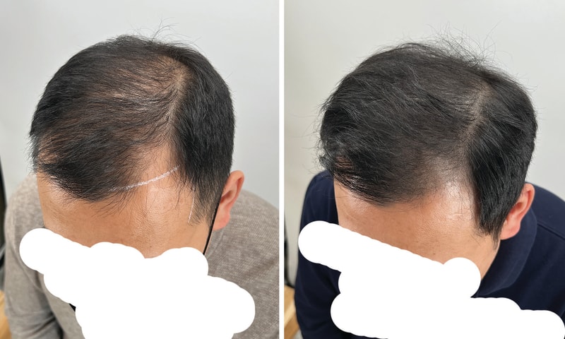 頭皮タトゥー完了。チンレギ