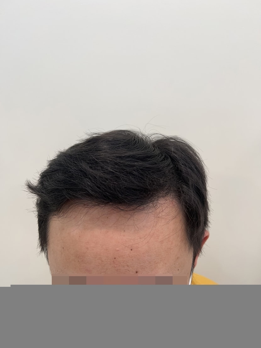 이마가 점점 넓어지고 있어요
