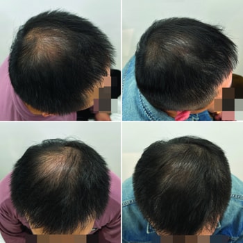 위에 조명이 가까워서 두피가 빛나는 건 어쩔 수가 없네요 ㅠㅠ