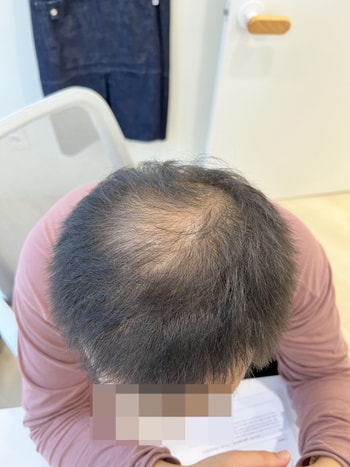 42살의 정수리 입니다...