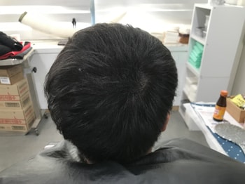시술마무리