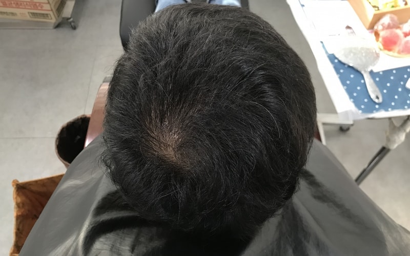 頭皮タトゥー後記