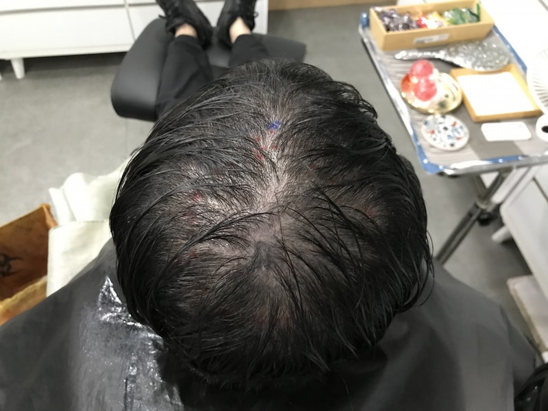 頭頂頭皮タトゥー後記