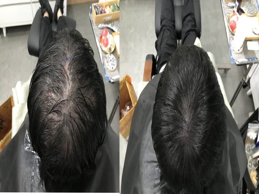 두피문신 시술전후