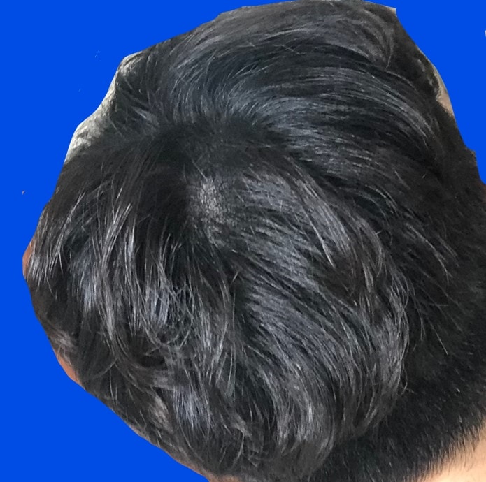 시술이후 저녁(적당한 조명)