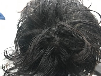 병원에서 제공해준 사진(시술직후 젖은머리)