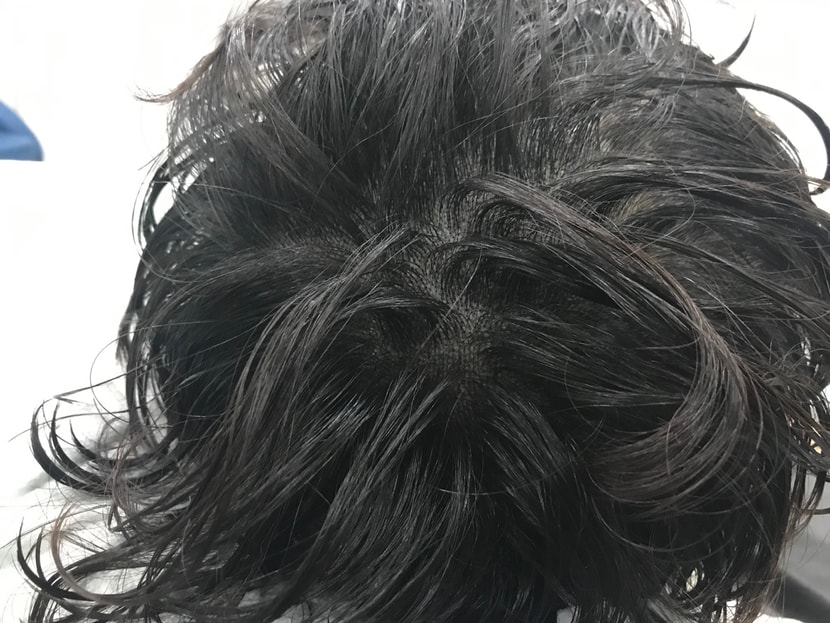 병원에서 제공해준 사진(시술직후 젖은머리)