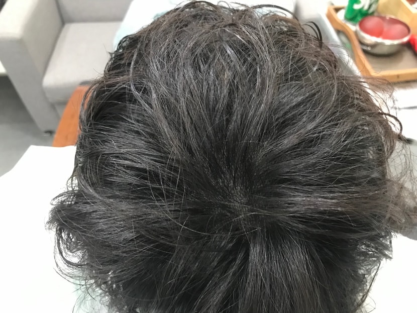 병원에서 제공해준 사진(시술직후 건조머리)
