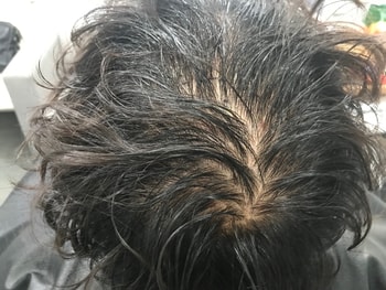 병원에서 제공해준 사진(시술당일 젖은머리)