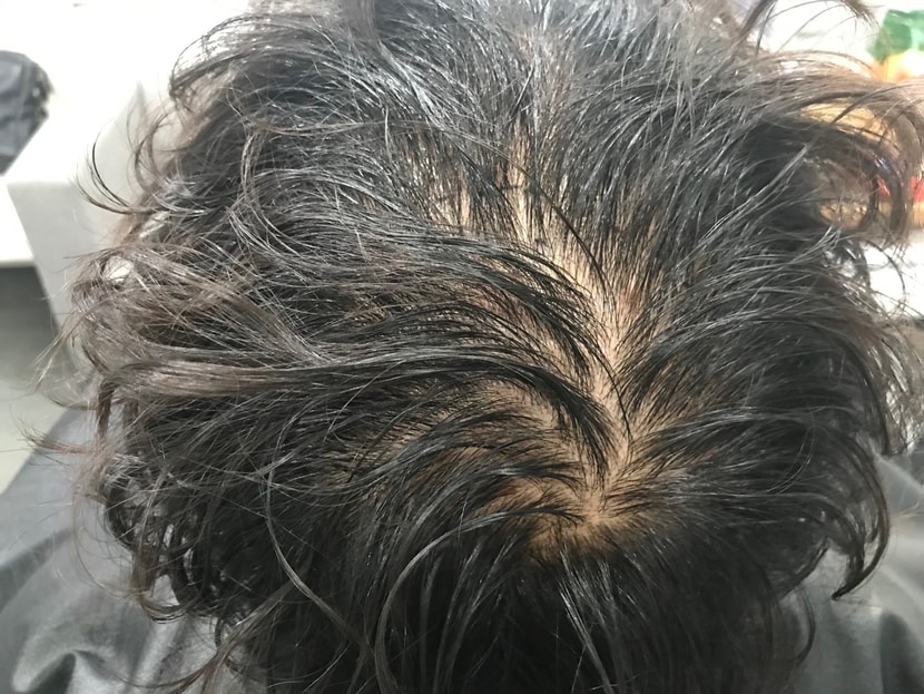 병원에서 제공해준 사진(시술당일 젖은머리)