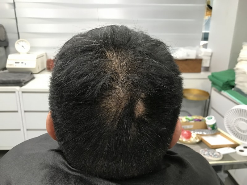 頭皮タトゥーのレビューです