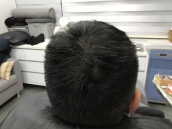 시술 후