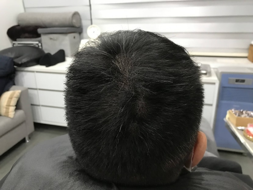 시술 후