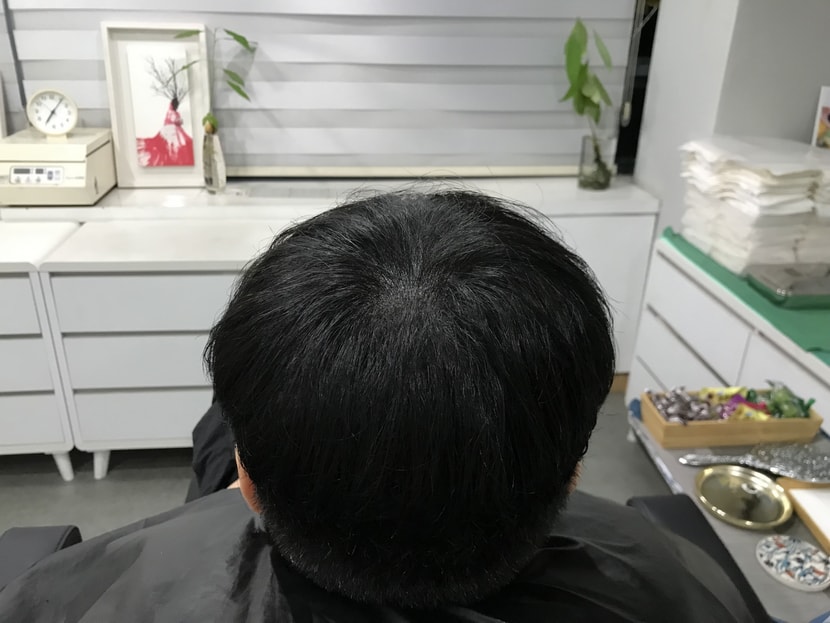 시술후
