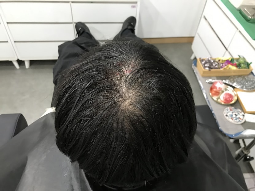 시술전(젖은머리)