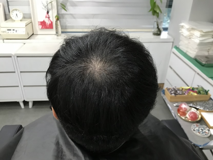 시술전
