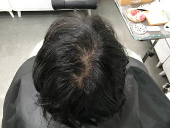 시술 전