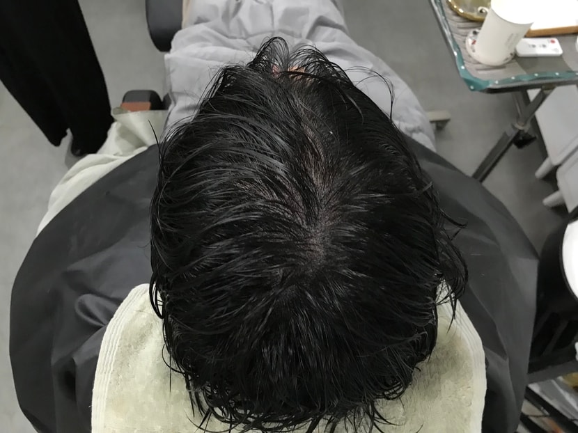 시술 후 젖은 머리