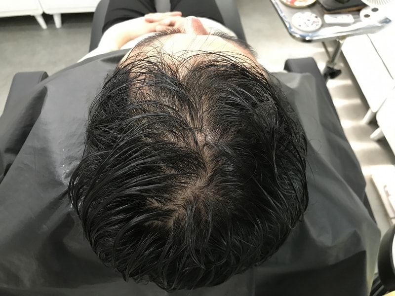 頭皮のタトゥー体験談をアップします！ （写真修正）