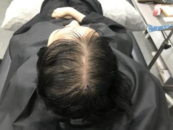 시술전