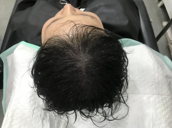 시술후