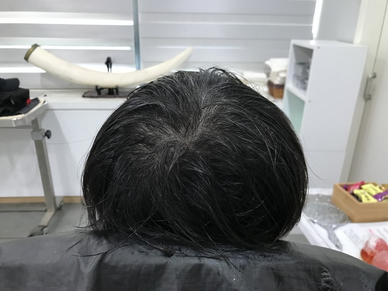 [延世美达人] 头皮纹身 第二集后记