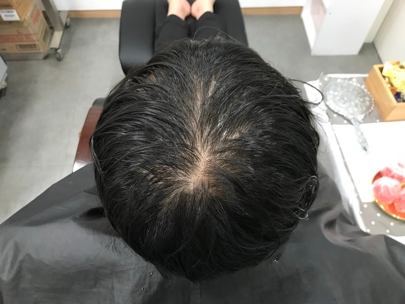 头皮纹身1次后记~~