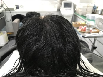 시술 후 정말 감쪽같죠!!!