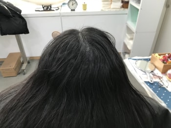시술 후입니다 두피가 조금 더 빡빡해졌죠?