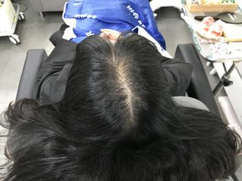 시술 전 저의 훤한 정수리 보이시나요