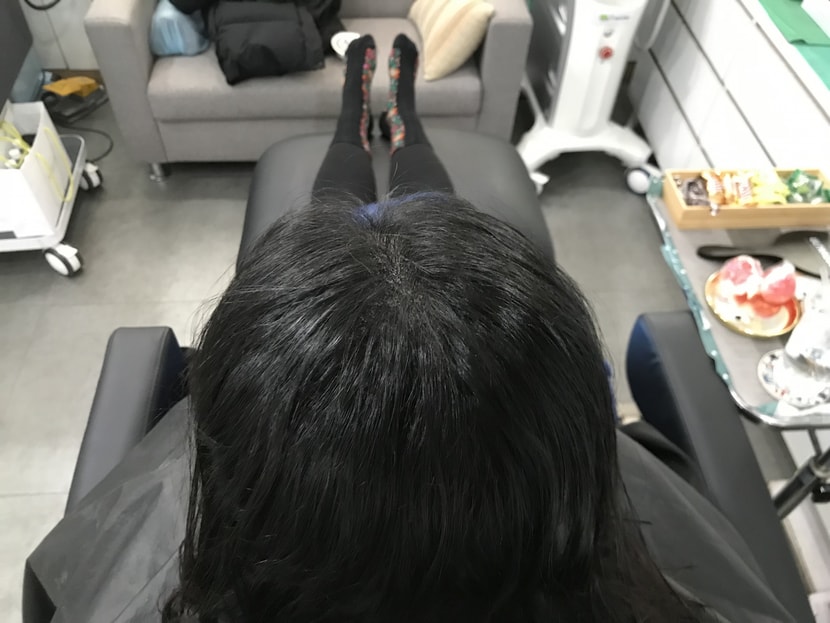정수리 고속도로가 없어졌어요ㅠㅠ 감격!!!