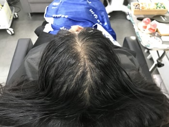 이거는 저의 두피문신 전 모습입니다 차이가 얼마나 큰지 아시겠죠?