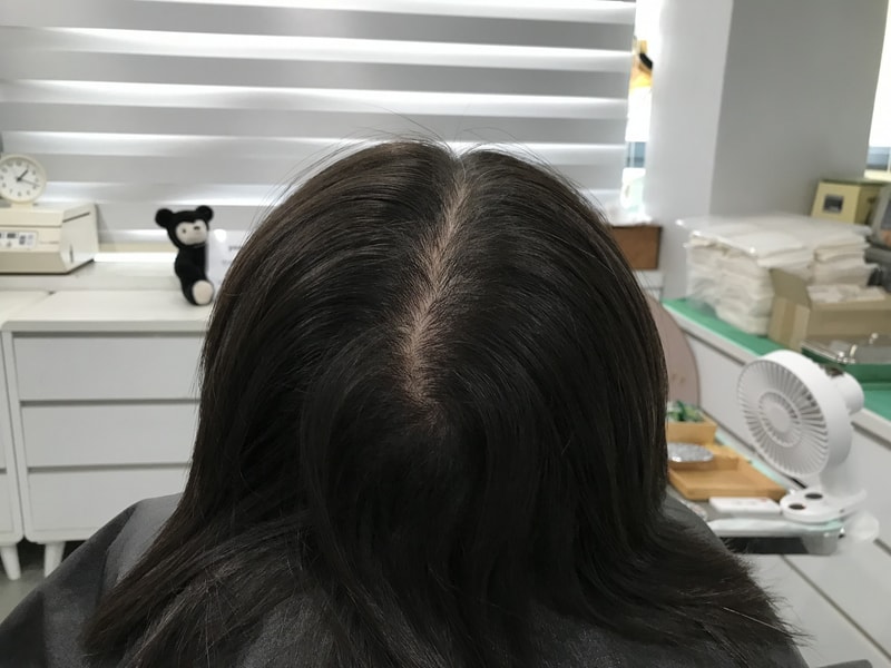 연세미다인 두피문신 1차 후기