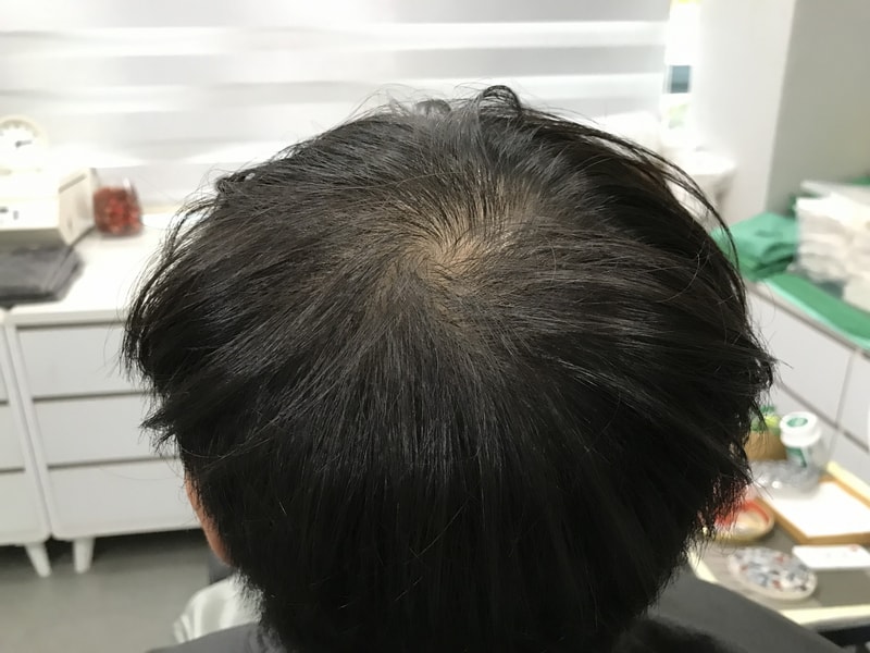 延世ミダイン 樹脂鍼 ミセドット 体験談