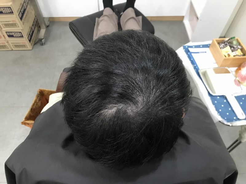 [Midain] 这是头皮纹身后记