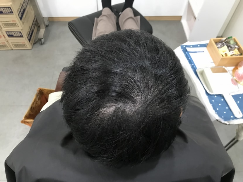 시술 전 1