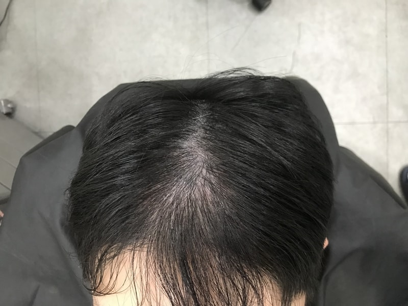 연세 미다인 전두부 두피문신 후기