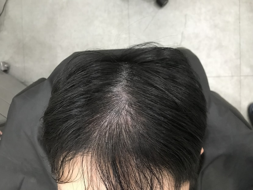 두피문신 전 1